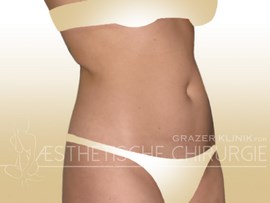 Lipo-12-Bauch-Flanken-Po-vorher