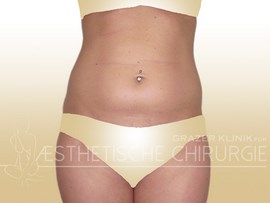 Lipo-31a-Bauch-Flanken-vorher