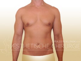 Lipo-Mann-Bauch-Flanken-Brust-12a-vorher