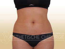 Lipo_34a_Bauch_Flanken_vorher_f