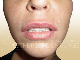 Lippen-1-nachher