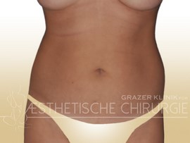 lipo-11-bauch-flanken-vorher