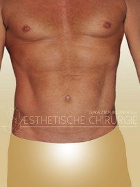 lipo_mann_bauch_flanken_16_nachher_f