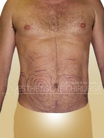 lipo_mann_bauch_flanken_16_vorher_f