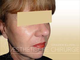 Facelift-nachher