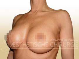 Brustvergrößerung Nachher Körbchengröße C