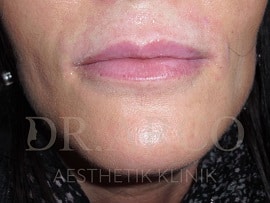 Lippen vorher