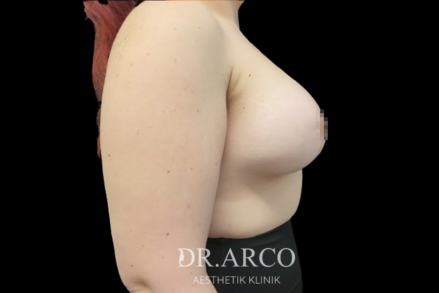 Brust – Zustand vor dem Eingriff