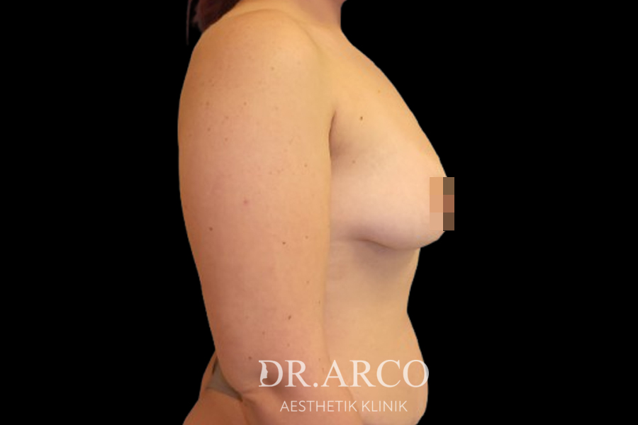 Brust – Zustand vor dem Eingriff