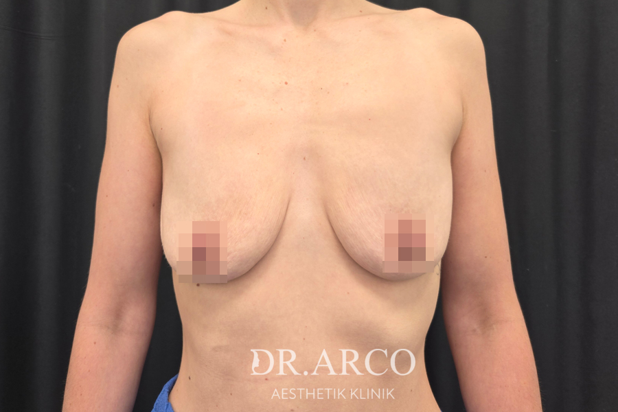 Brust vor der Operation mit starker Hautüberdehnung