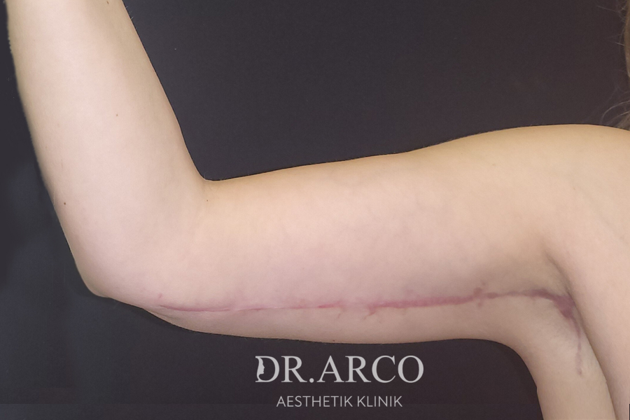 Oberarme nach der OP bei Dr. Arco