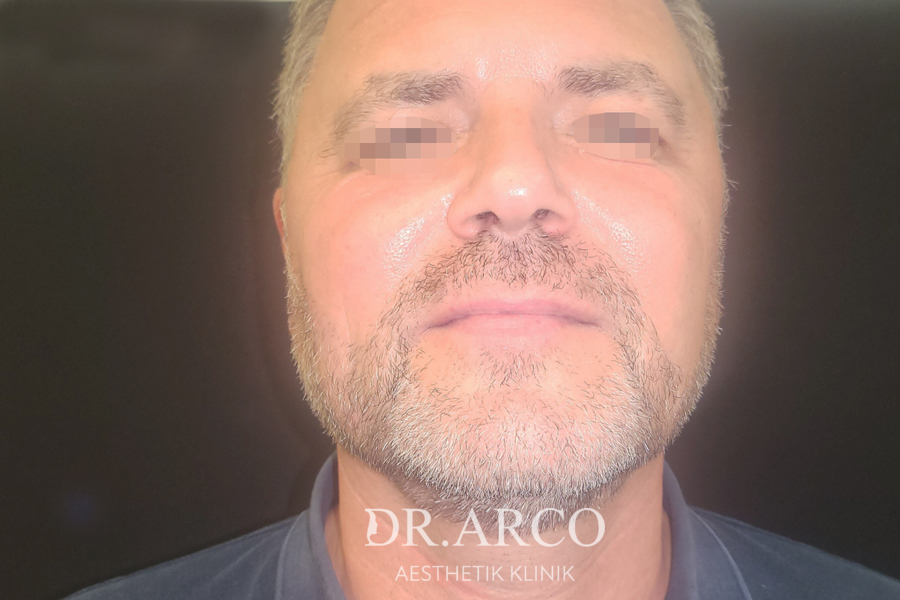 Vor der Oberlidstraffung beim Mann bei Dr. Arco