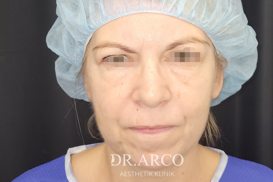Vor der Oberlidstraffung einer Patientin bei Dr. Arco
